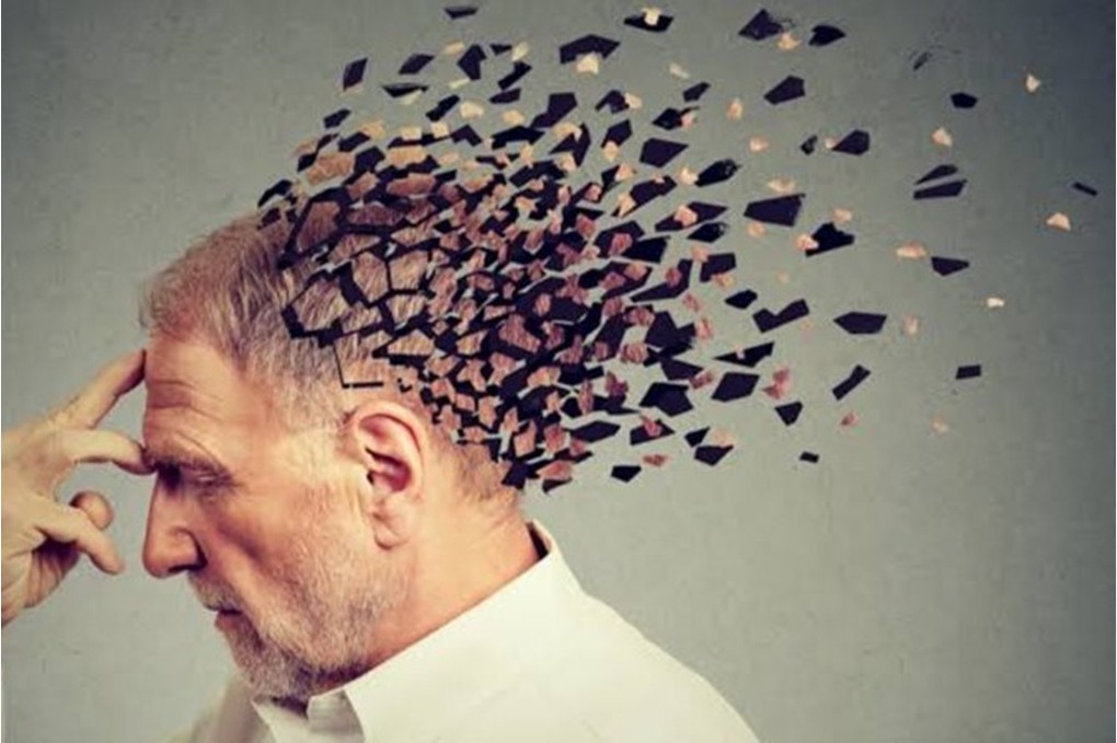 دراسة تربط الزهايمر بعدوى بكتيرية مصدرها اللثة 