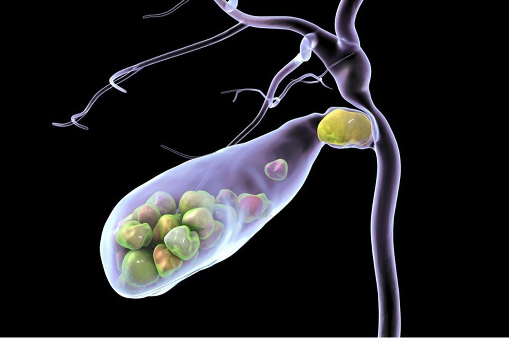 اكتشاف ارتباط عنصر شائع في نظامنا الغذائي بحصوات المرارة 