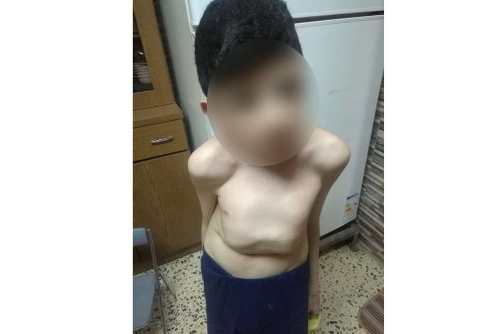 بعد سنوات من المتابعة .. أب يطرق أبواب وزارة الصحة لعلاج ابنه المصاب بانحناء العمود الفقري 